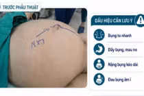 Nữ sinh 17 tuổi mang khối u buồng trứng hơn 10kg 