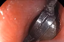 Bé trai 5 tuổi tổn thương đường tiêu hóa sau khi nuốt nhiều viên nam châm