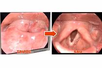 Một cơn đau họng cấp, người phụ nữ phù nề thanh quản đe dọa tính mạng