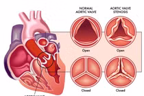Bác sĩ mách dấu hiện sớm phát hiện bệnh van tim mọi người thường bỏ qua