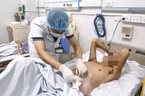 Rò đại tràng gây áp xe phổi khổng lồ, người đàn ông 54 tuổi nguy kịch