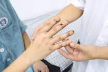 Suýt phải tháo khớp các ngón tay vì nhiễm trùng hoại tử do tự điều trị