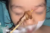 Que xiên thịt đâm từ mũi lên hốc mắt, bé gái 2,5 tuổi thoát nguy cơ xuyên sọ