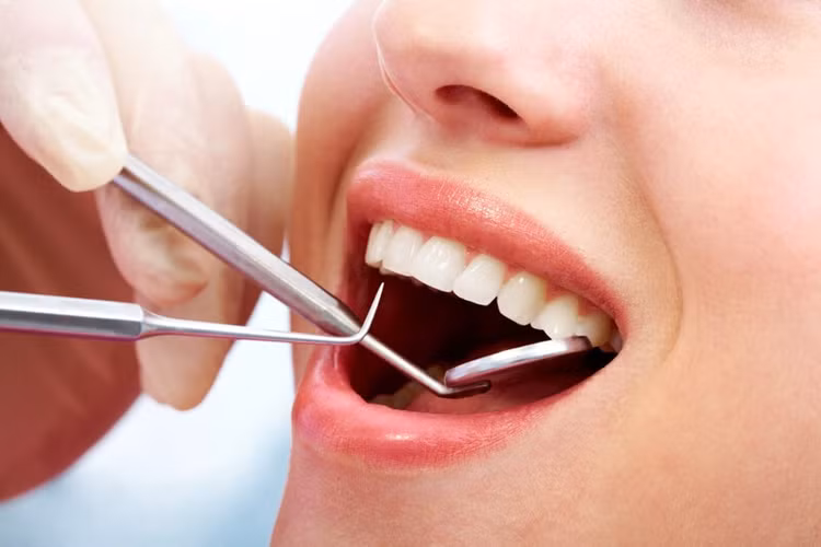 Răng mọc lạc chỗ là những răng không nằm đúng vị trí của chúng trên cung hàm mà mọc ở những chỗ khác.