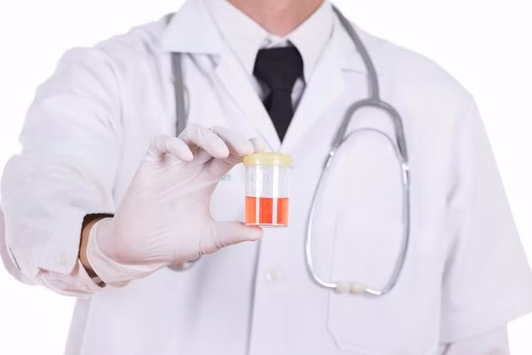 Tiểu máu với nước tiểu màu hồng hoặc màu cola là một triệu chứng của hội chứng viêm cầu thận. Ảnh minh hoạ/Internet