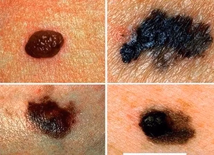 Nốt ruồi phát triển bất thường là dấu hiệu điển hình của bệnh. Ảnh medlatec.vn