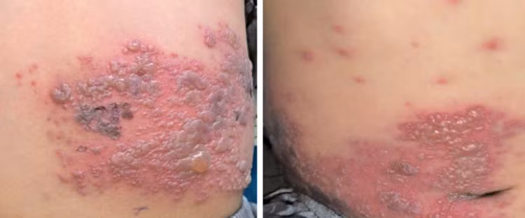 Hình 1: tổn thương mụn nước tập trung thành đám trên nền dát đỏ phân bố ở ngực, lưng ở bên phải. Ảnh BV Da liễu TW