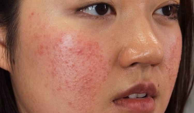 Mỹ phẩm kém chất lượng chứa nhiều hoạt chất nguy hiểm khiến làn da hư hỏng nặng. Ảnh minh họa/Nguồn vneconomy.vn