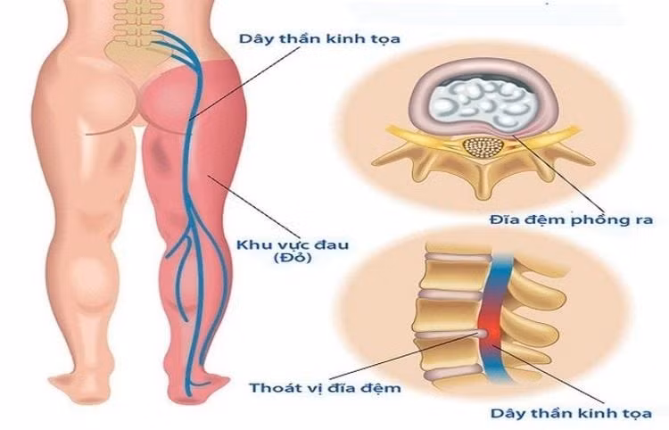 Vị trí dây thần kinh tọa/ Ảnh vinmec.com
