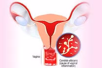 Nhận biết nhiễm nấm âm đạo như thế nào?