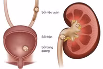 Triệu chứng cảnh báo sỏi niệu quản, không nên bỏ qua