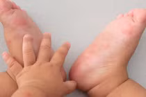 Phòng tránh bệnh tay chân miệng cho trẻ nhỏ trong mùa dịch