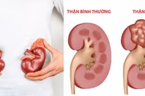 Bé trai người Lào hồi phục kỳ diệu sau điều trị hội chứng thận hư tại Nghệ An