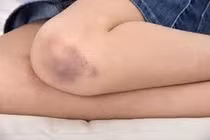 Bé trai 6 tuổi suýt mất mạng khi bị chấn thương ở đầu gối