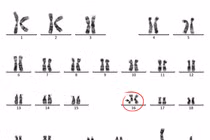 Khám tiền sinh sản, nam thanh niên bất ngờ phát hiện nhiễm sắc thể bất thường