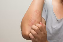 Mùa mưa tăng nguy cơ nhiễm ký sinh trùng, đừng chủ quan với ngứa kéo dài