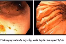 Tự ý dùng thuốc giảm đau có thể gây biến chứng nguy hiểm, cảnh báo từ bác sĩ