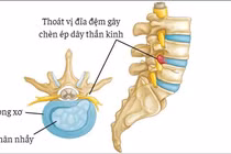 Phẫu thuật thoát vị đĩa đệm cột sống cổ giúp nam thanh niên thoát liệt