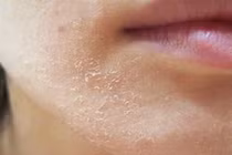 Mẹo giữ làn da khỏe mạnh trong mùa đông lạnh giá