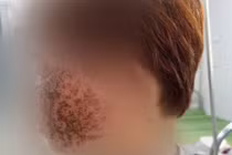 Nhiễm virus Herpes trên da có thể dẫn đến biến chứng nặng nếu không điều trị kịp thời
