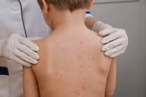 Phòng ngừa thủy đậu hiệu quả trong mùa đông xuân