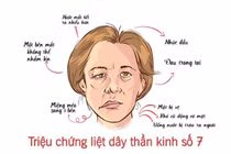 Liệt dây thần kinh số 7: Nhận biết sớm để tránh biến chứng nặng