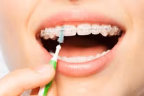 Khi niềng răng, vệ sinh răng miệng thế nào?