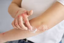 Chăm sóc da đúng cách mùa đông để giảm vảy nến