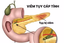 Nguy cơ viêm tụy cấp sau dịp lễ tết do ăn uống quá độ