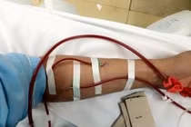 Cứu sống bệnh nhân suy tim cấp nặng nhờ kỹ thuật lọc máu liên tục