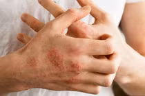 Liệu pháp tế bào CAR-T đang được thử nghiệm để điều trị bệnh tự miễn