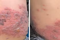 Bé trai 4 tuổi mắc cùng lúc Zona và Thủy đậu, trường hợp hiếm gặp trong y văn