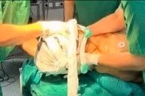 Người đàn ông bị trật đốt sống cổ phức tạp