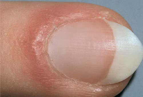 Bất thường trên móng tay tiết lộ sức khỏe của bạn