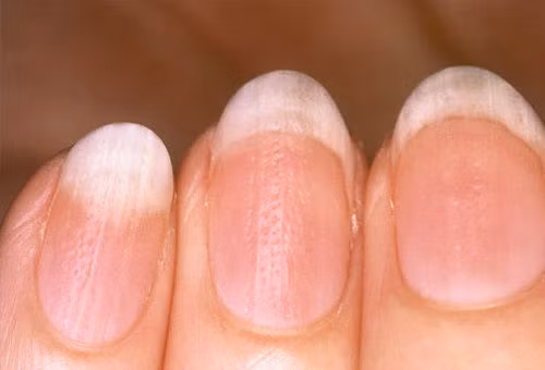 Bất thường trên móng tay tiết lộ sức khỏe của bạn