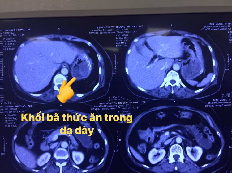 tac-ruot-do-hong-3-khoi-ba-thuc-an-trong-da-day.jpg