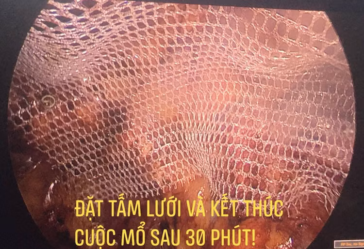 thoat-vi-ben.jpg