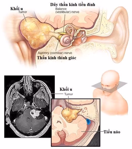 u-day-than-kinh-thi-giac-vi-chong-mat.jpg