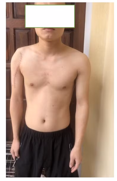 nang-xuong-phinh-mach-2.png