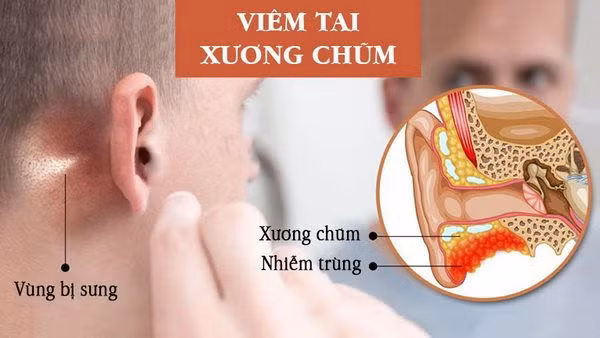 viem-tai-xuong-chum.jpg