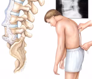 viêm cột sống dinh khớp