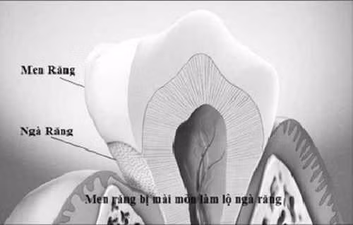Men răng bị mài mòn làm lộ ngà răng gây đau và ê buốt chân răng.