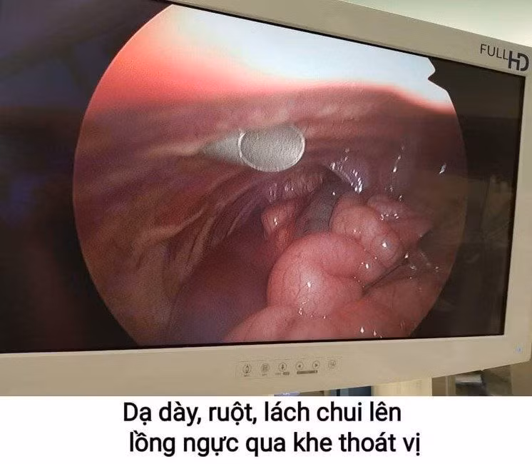 thoat-vi-hoanh.jpg