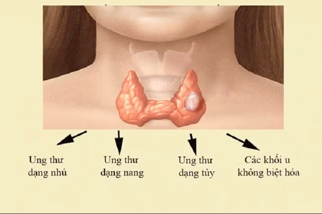ung-thu-tuyen-giap1.png