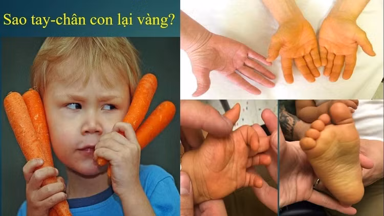 vang-da-tay-chan-tre.jpg