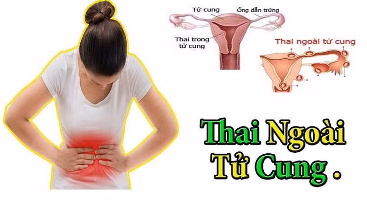 thai-ngoai-tu-cung.jpg