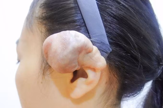 U phì đại vành tai sau khi bấm lỗ tai.