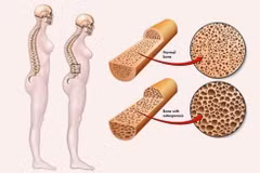 30-40% phụ nữ mãn kinh loãng xương, uống canxi tùy tiện dễ rước thêm nguy cơ