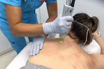 Trị mụn lưng tại spa, nữ bệnh nhân bị ngộ độc thuốc gây tê