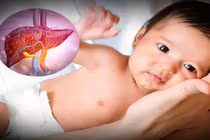 Nguy cơ viêm gan bí ẩn ở trẻ em, dấu hiệu cần lưu ý